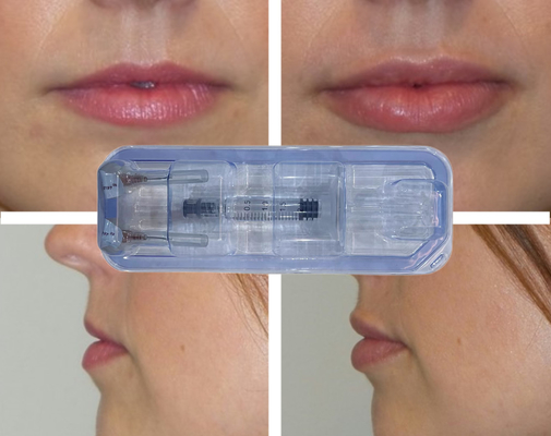 CE Injectable Crosslinked Hyaluronic Acid Filler Lip Injection 24mg/Ml