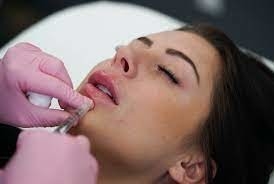 GMP Juvederm Ultra 3 HA Dermal Filler For Lip Juvederm Vollure